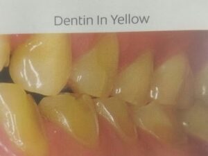 What is Enamel Erosion and How it Effect