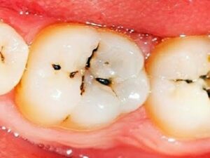 Adult’s Cavities Treatment