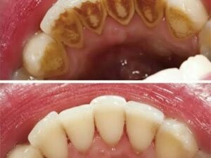 Prevent Gum Disease by Brushing