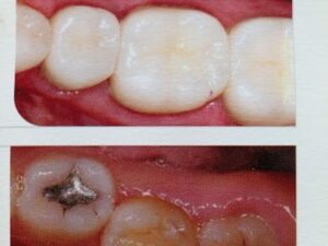 How the Dental Fillings Help You to Restore a Tooth