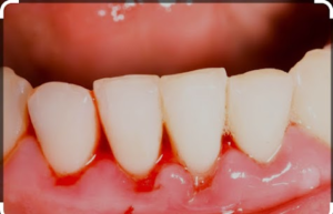 Know about the Bleeding Gums