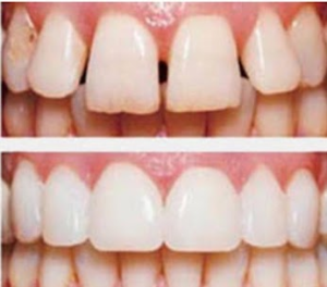 Treating Spacing in teeth