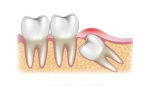 Third Molar Disimpaction
