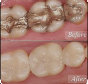 Know About The Composite Fillings