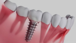 What Is The Dental Implants ?