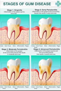 What Is The Stages of Gum Disease ?  