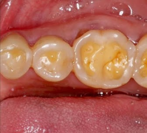 How Tough Is Tooth Enamel ?