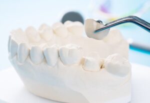 Dental Crowns Explained: Key Benefits and What Beginners Need to Know
