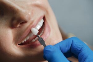 Dental Veneers: What You Need to Know
