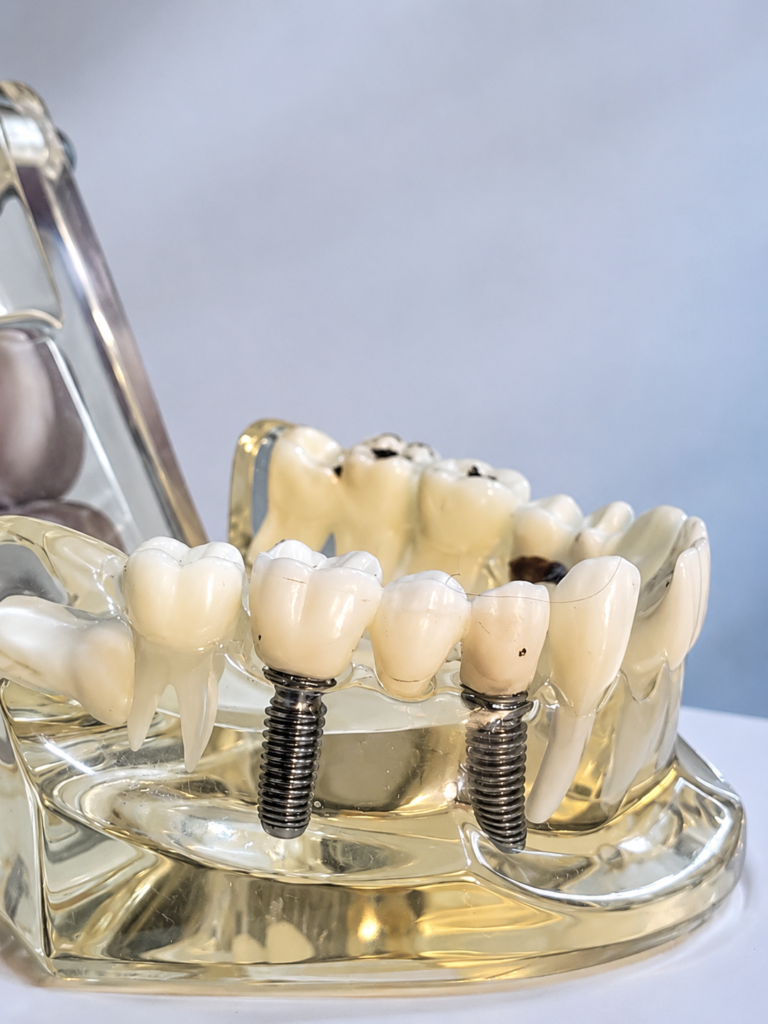 Dental Implants in Hinjawadi Pune