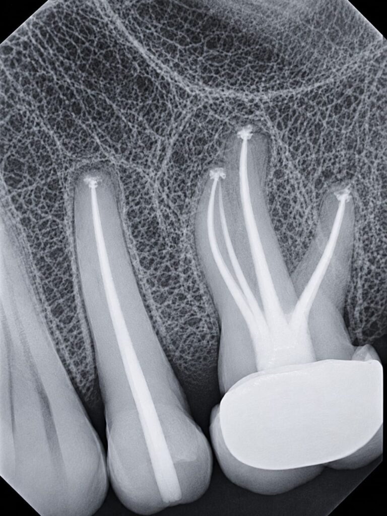 root canal treatment in hinjawadi,pune